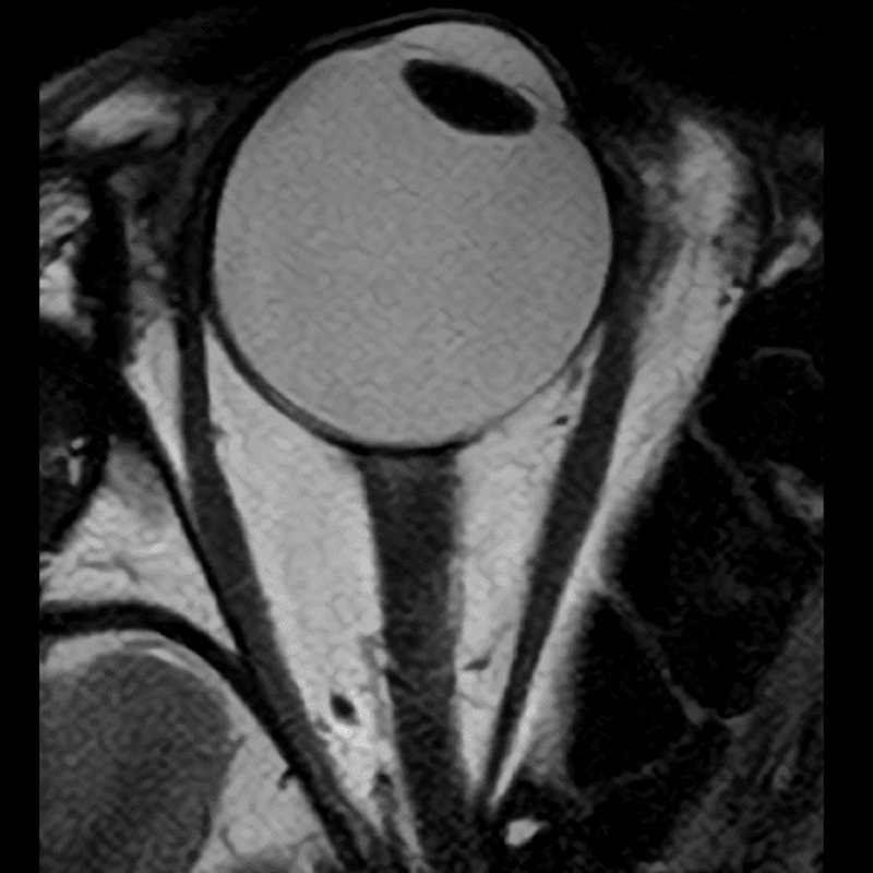 Sag T2W for Pituitary: PIQE 3x3