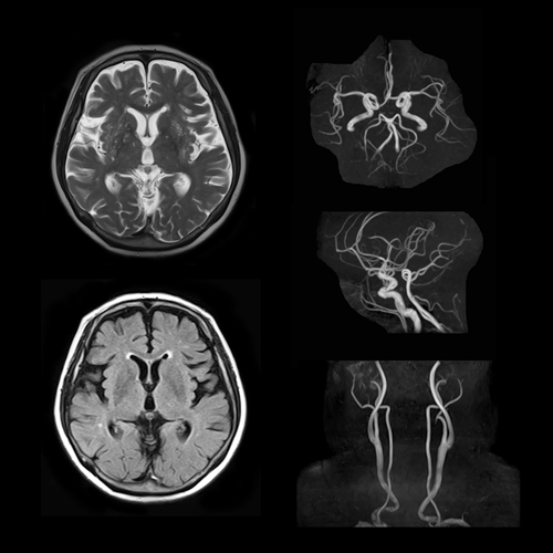 MRI and MRA of Brain and Neck