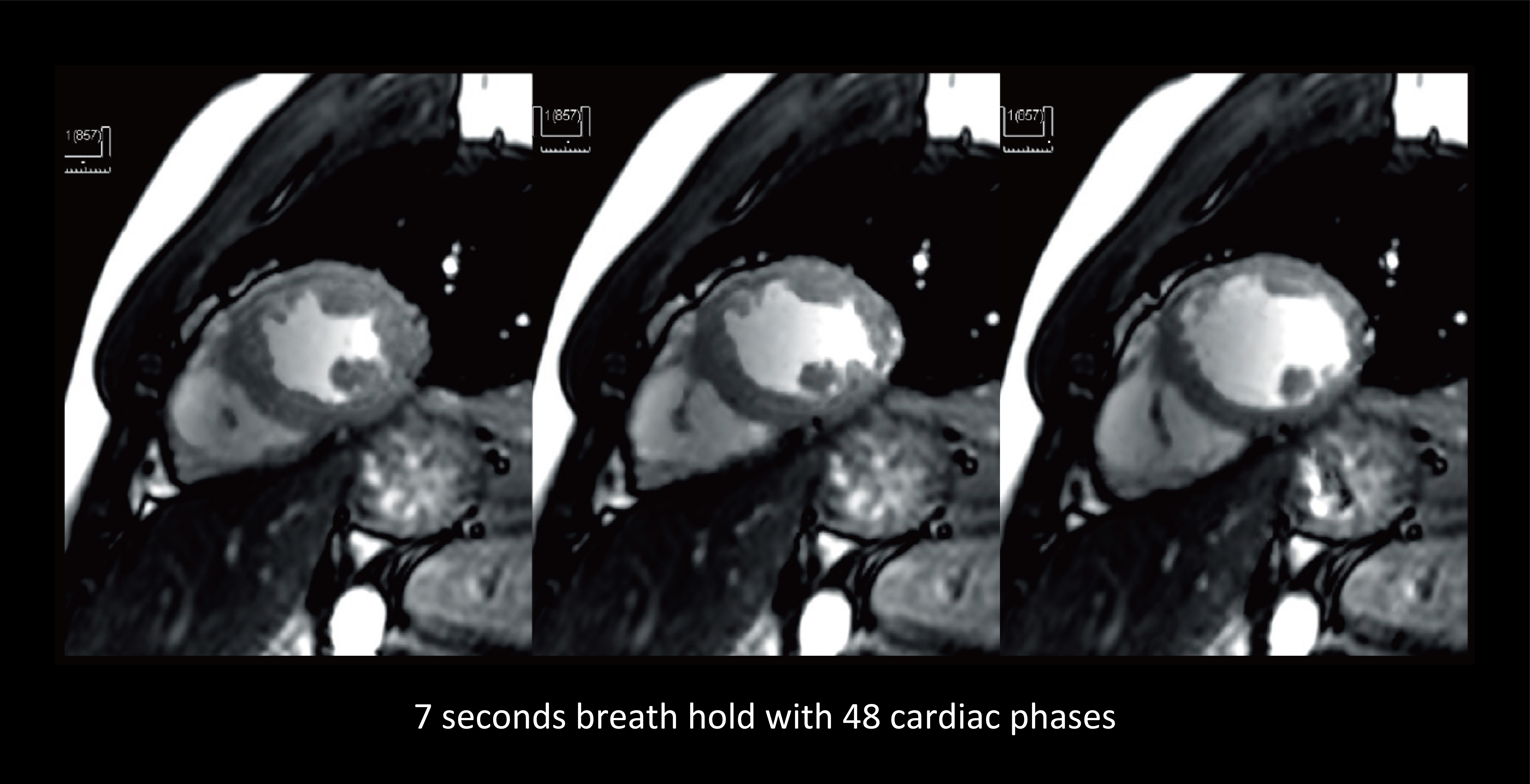 k-t SPEEDER: 7 seconds breath hold with 48 cardiac phases