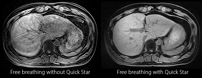 Free breathing without Quick Star vs Free breathing with Quick Star