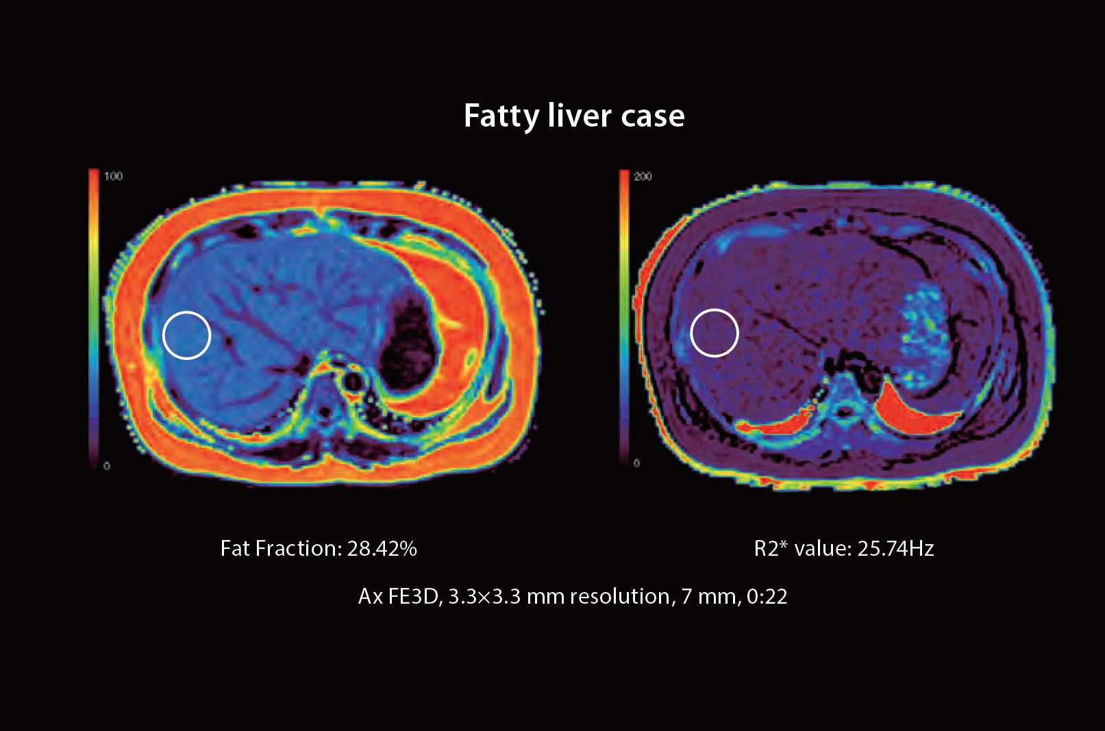Fatty Liver Case