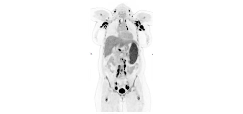 PET AiCE Clinical Case