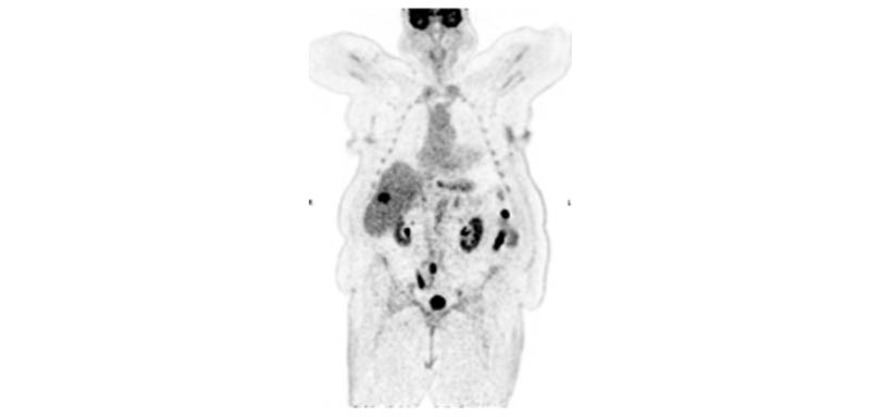 PET AiCE Clinical Case