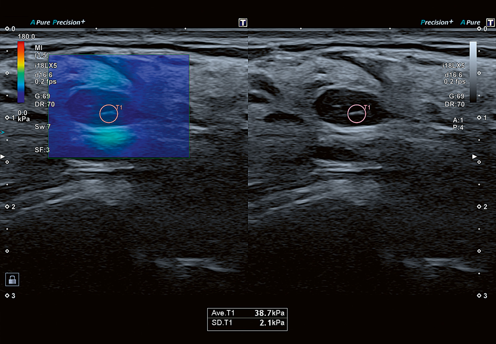 Breast lesion (medium)
