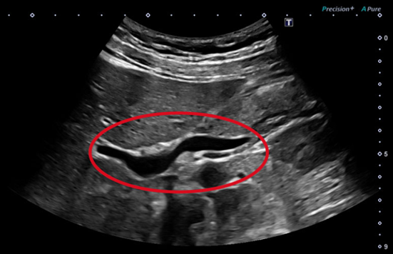 Common Bile Duct: 3-HI