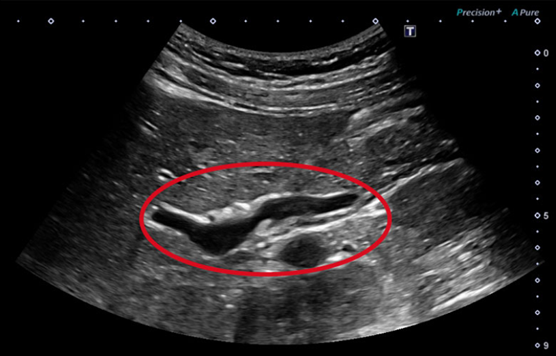 Common Bile Duct: Conventional