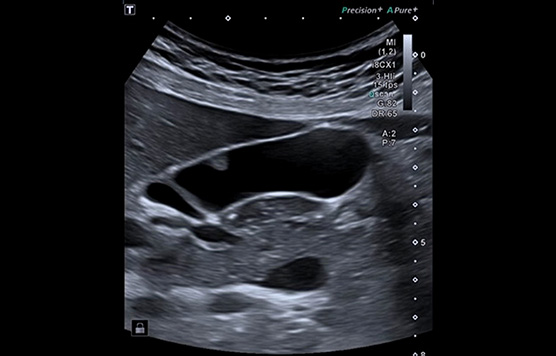Gallbladder: (3-HI), iBeam+, Full Focus