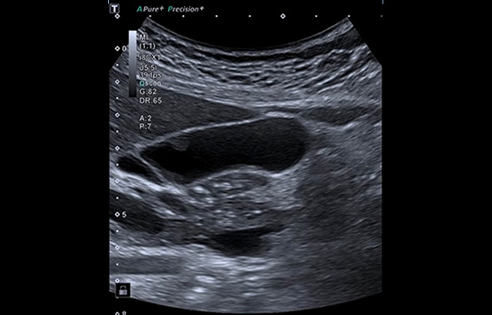 Gallbladder: Conventional Harmonics