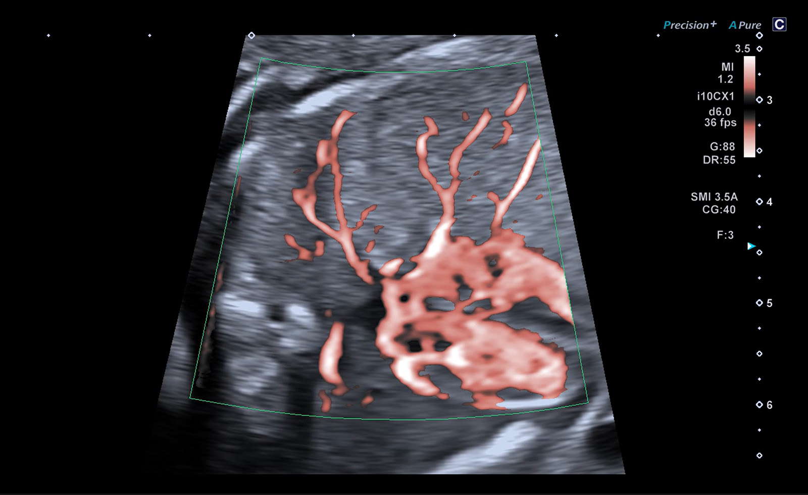 SMI Angio: Fetal Heart