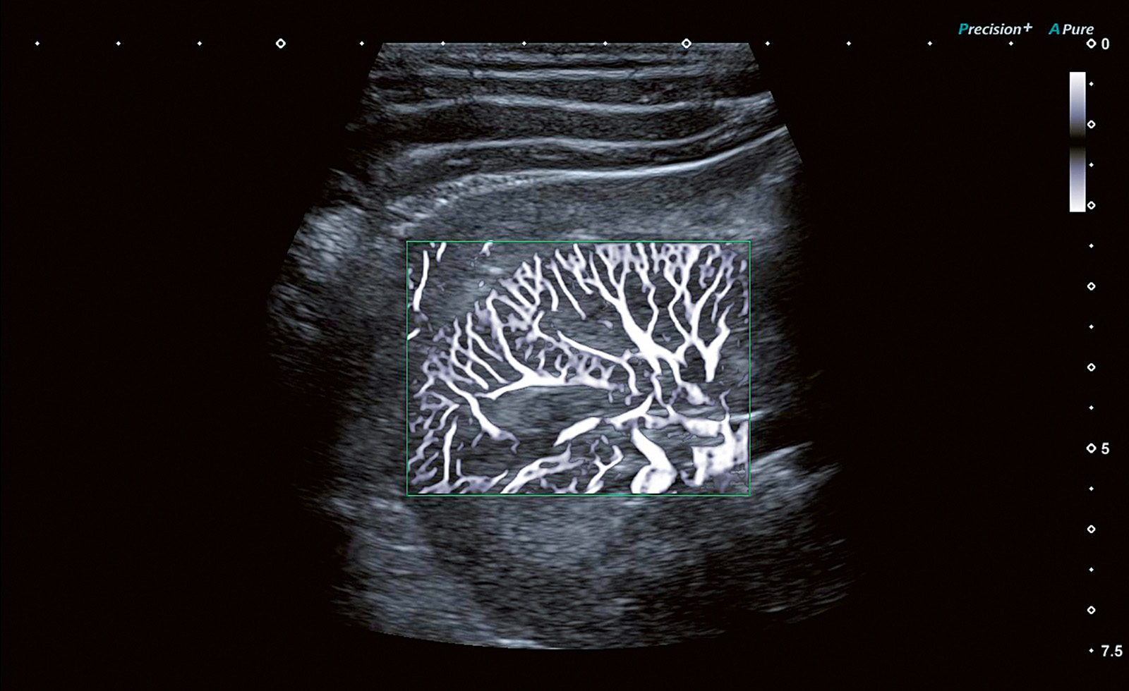 SMI Angio: Kidney