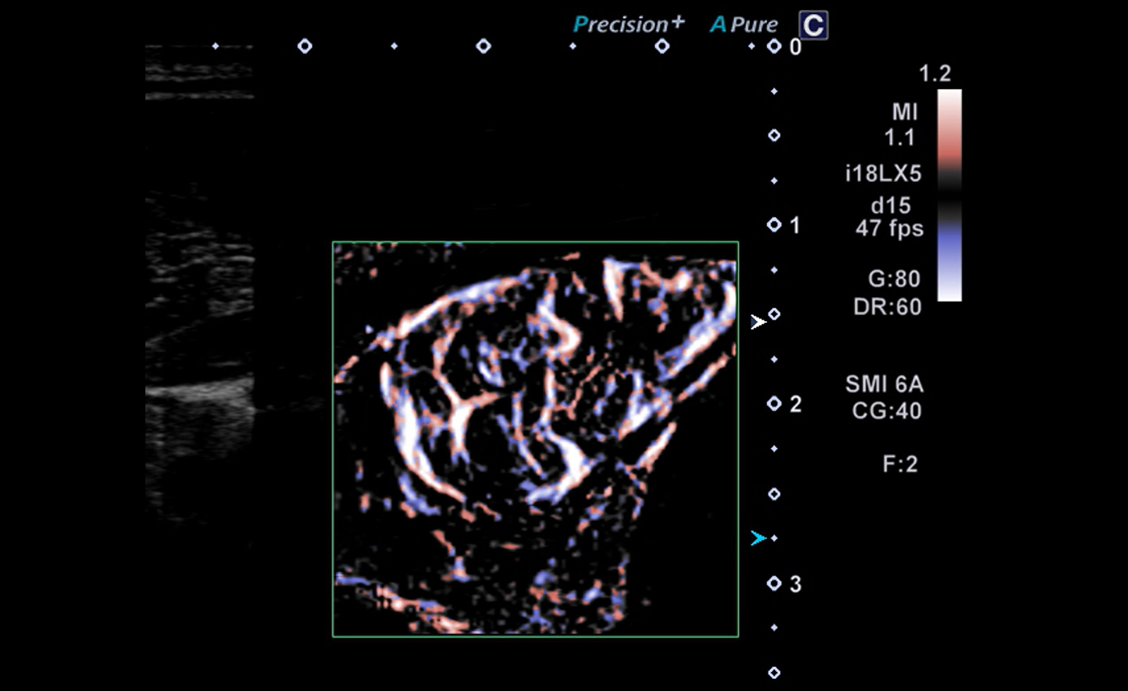 SMI Angio: Thyroid Nodule