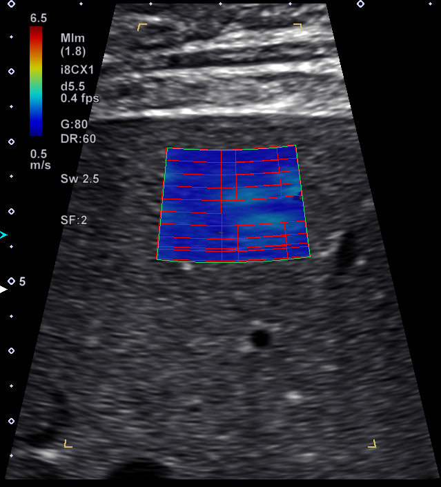 Shear Wave Elastography with MAD