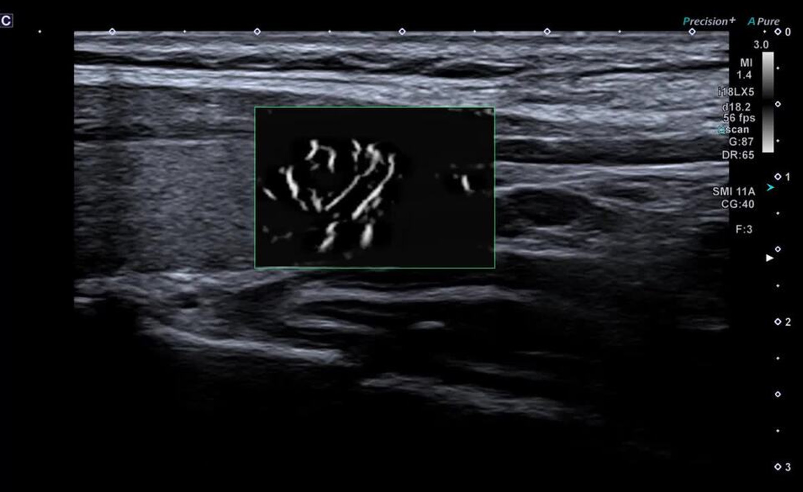 Thyroid