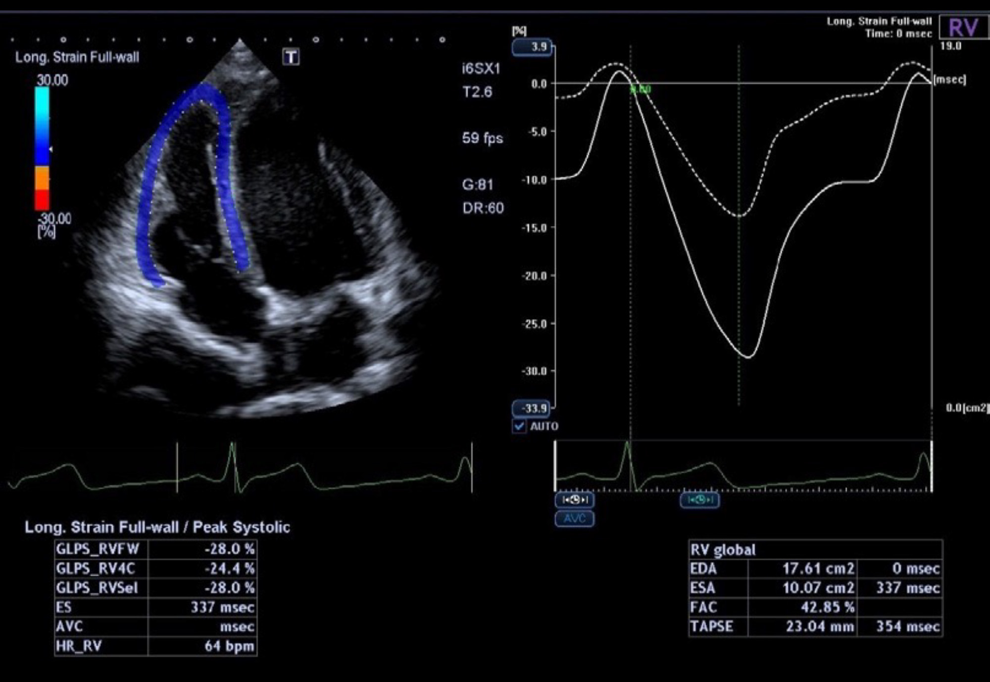 2D WMT for Right Heart