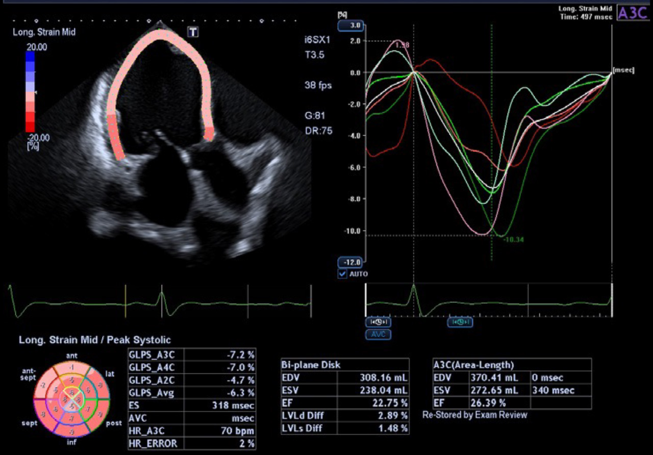 2D WMT with Auto Plane Detection