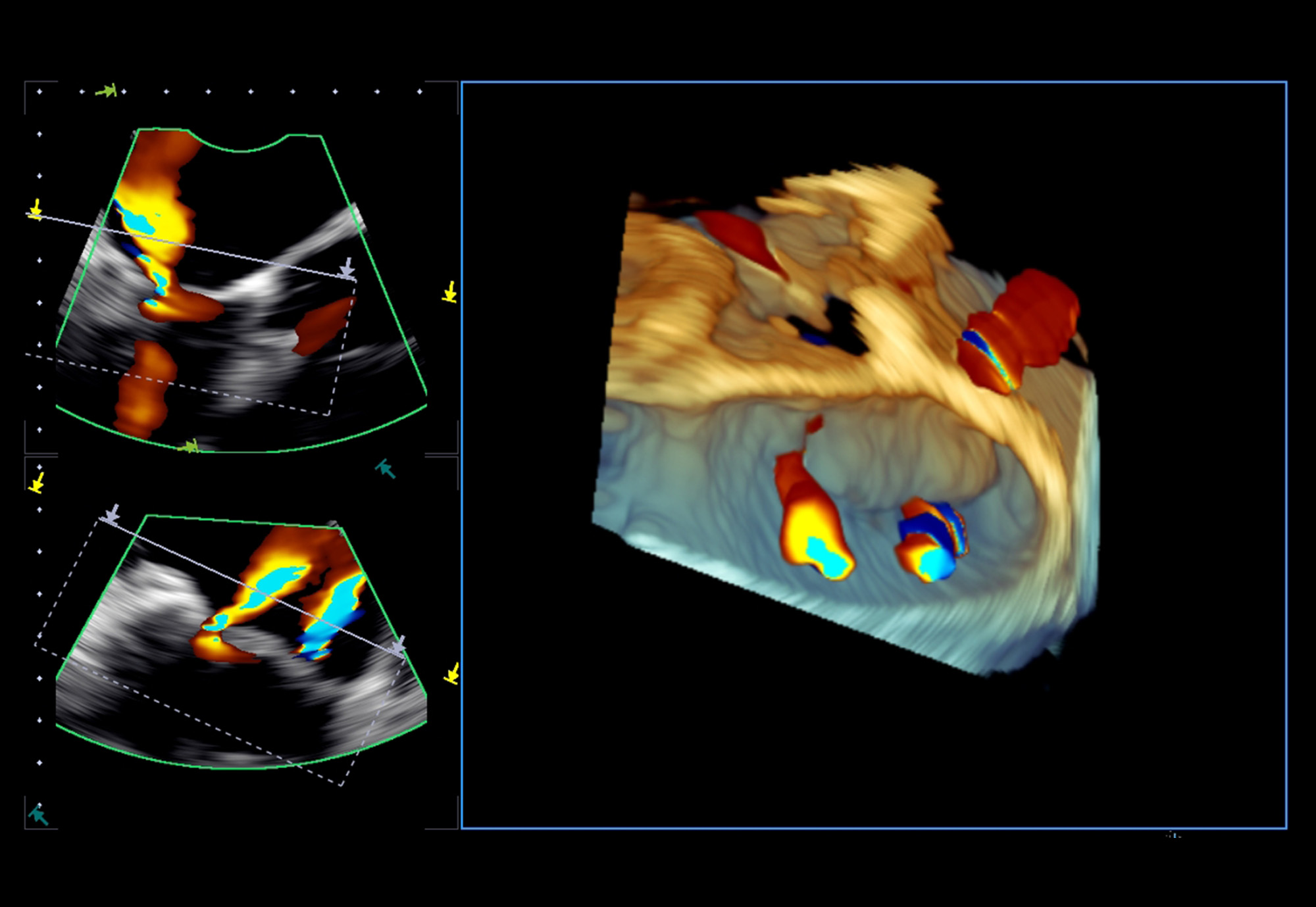 Extraordinary 4D TEE and CDI Imaging