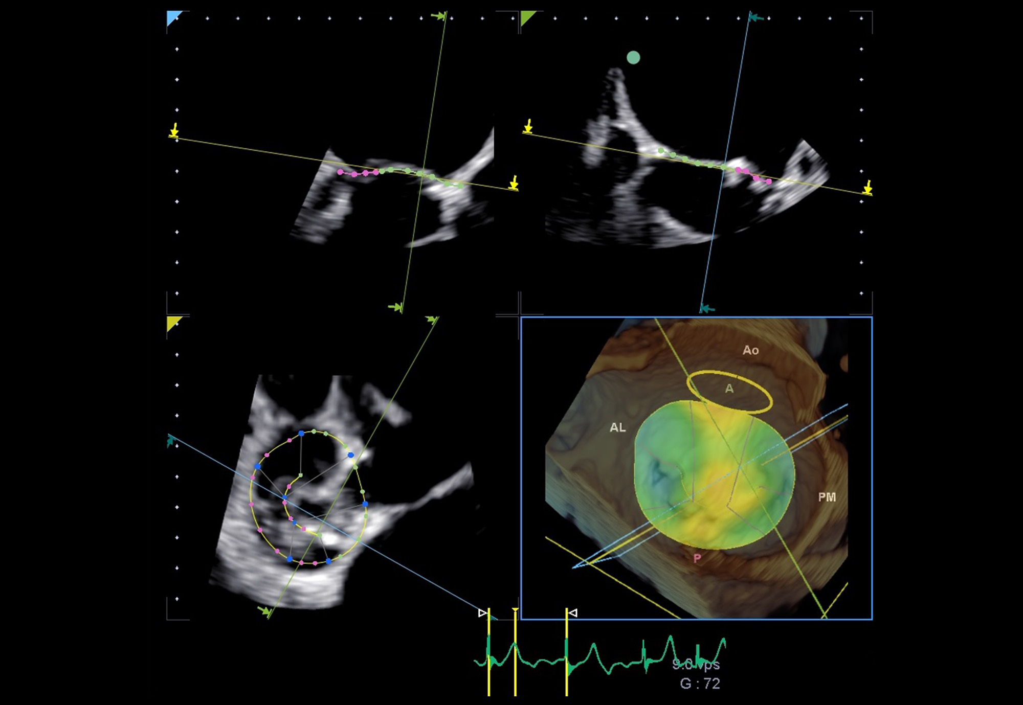 Mitral Valve Analysis