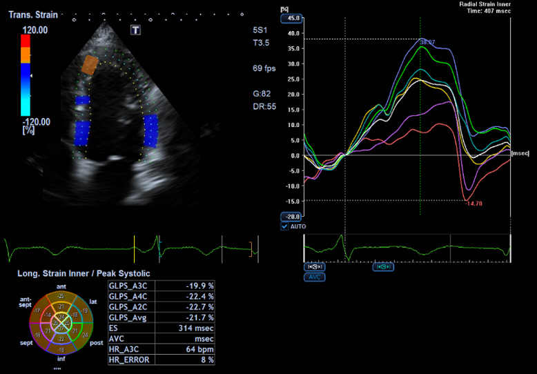 Display of DSI with different colors for analyzing on diastolic dysfunction.