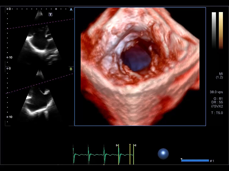 Pediatric Cardiac Volume Matrix Transducer Demo