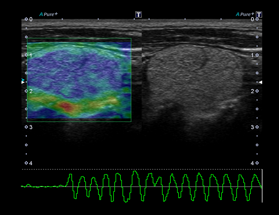 Real-time Elastography