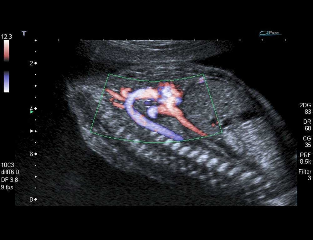 ADF on the Aortic Arch in a Fetal Heart