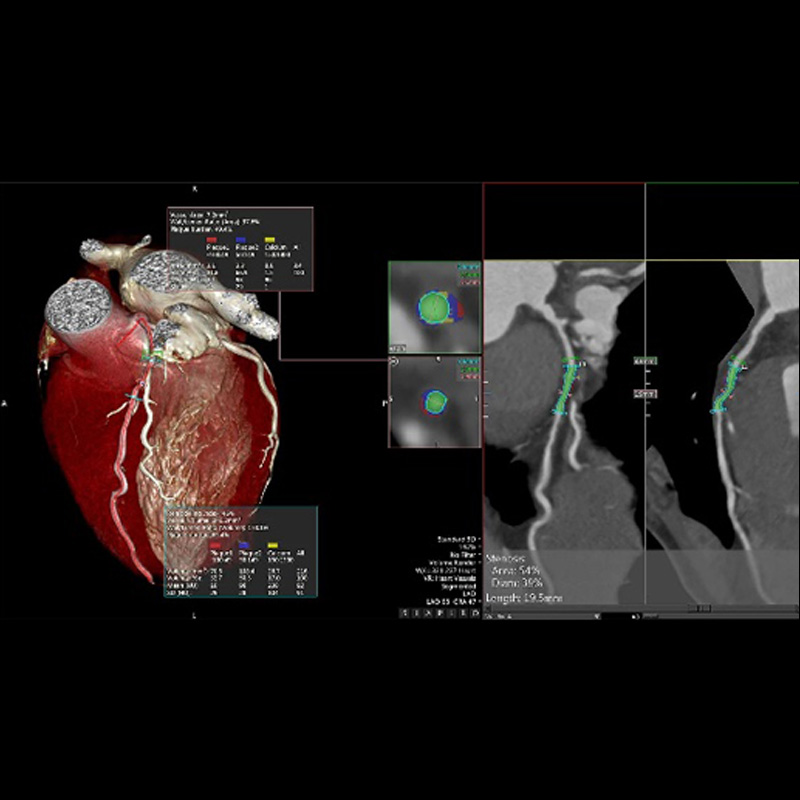 CT coronary analysis
