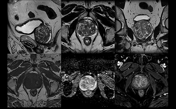 MR Prostate Clinical Image