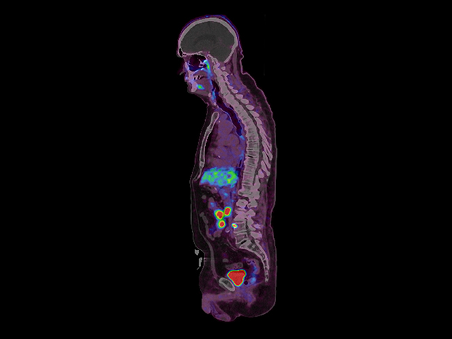 PET-CT Example