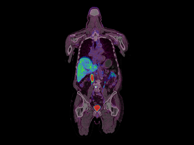PET-CT Example