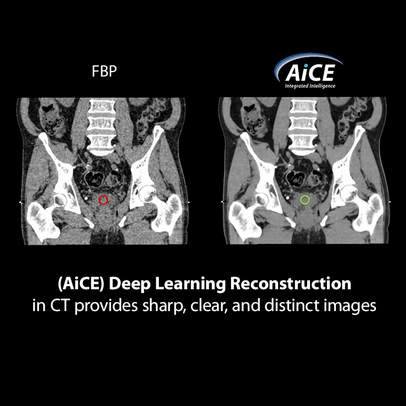 (AiCE) Deep Learning Reconstruction in CT provides sharp, clear, and distinct images
