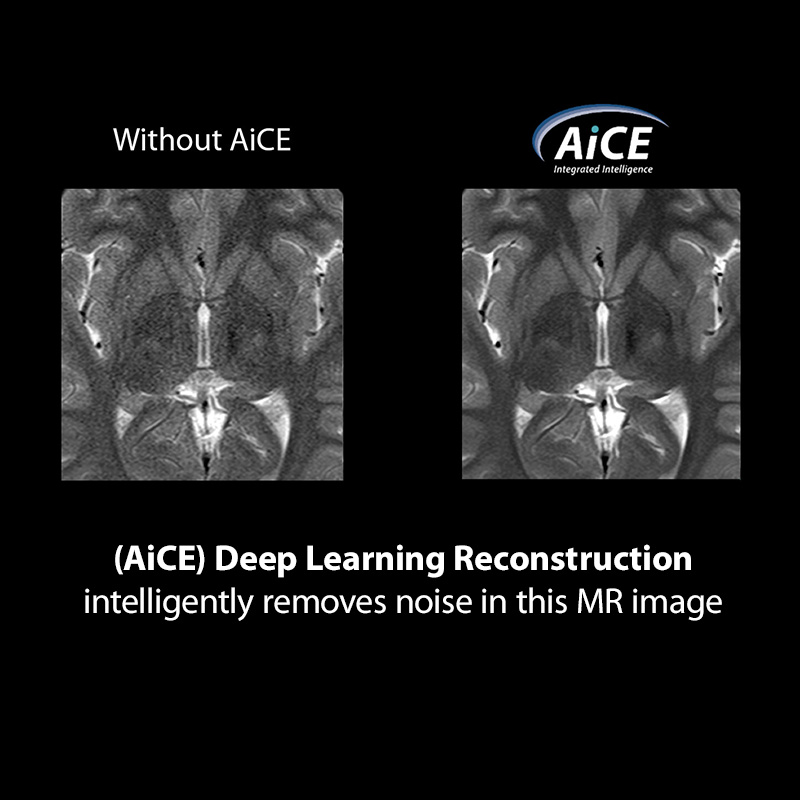 (AiCE) Deep Learning Reconstruction intelligently removes noise in this MR image