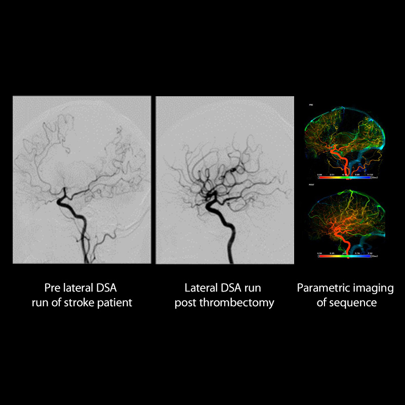 Pre lateral DSA run of stroke patient | Lateral DSA run post thrombectomy | Parametric imaging of sequence