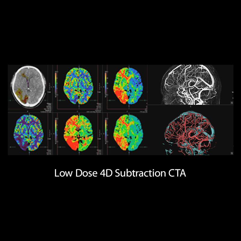 Low Dose 4D Subtraction CTA